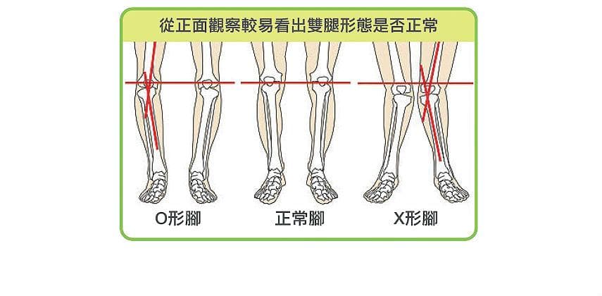 【健康生活】上班族小心前膝痛