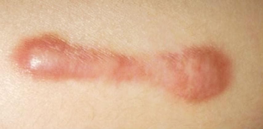 【健康生活】蟹足腫 係乜東東?